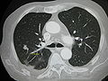 File:120px-LungMets2008.jpg