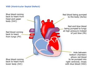 VSD