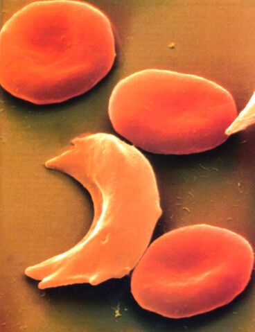 File:SickleCell 1222183673073.jpg
