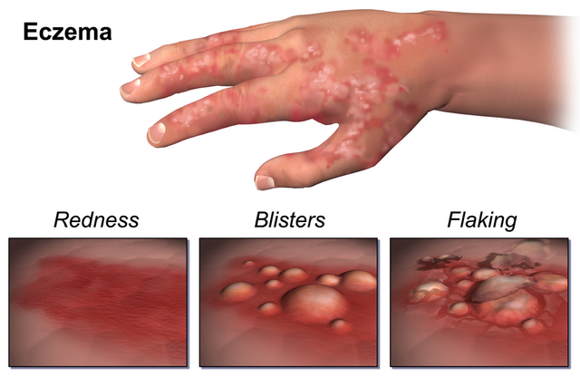 File:Eczema.png