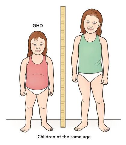 File:Growth-hormone-deficiency.jpg