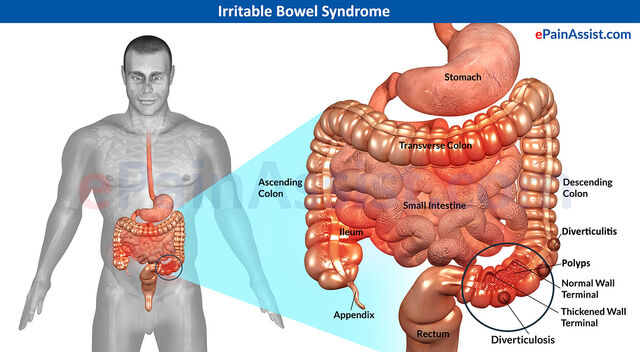 File:Irritable-Bowel-Syndrome-final.jpg