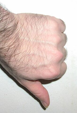 File:Thumbdown.jpg
