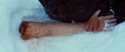 Franz Tomczeszyn's arm