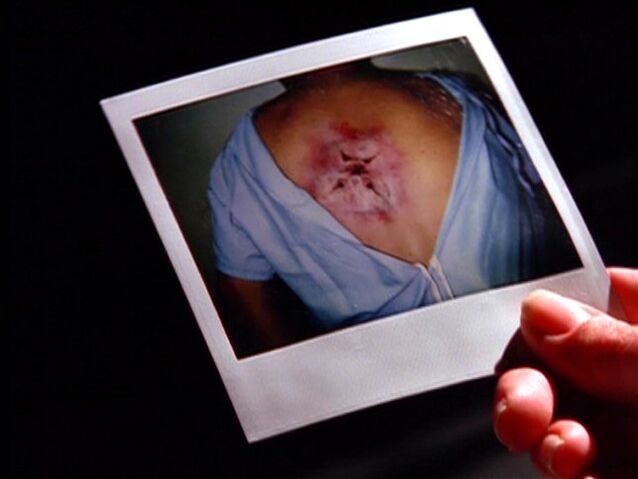 File:Flukeman wound in photograph.jpg